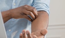 Atopiniam dermatitui būdinga labai sausa, stipriai niežtinti oda