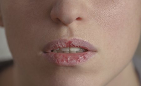 Jūsų oda - Moteris - Sausos lūpos Jūsų oda - Moteris - Sausos lūpos