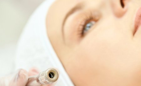 sensibio AR Intensyvios šviesos impulsų (IPL) terapija sensibio AR Intensyvios šviesos impulsų (IPL) terapija