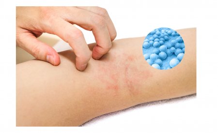 Atopiniam dermatitui (arba atopinei egzemai) būdingas odos paraudimas