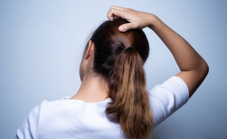 Galvos odos seborėjinis dermatitas Galvos odos seborėjinis dermatitas