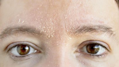 Jūsų oda - Moteris - Atopinis dermatitas Jūsų oda - Moteris - Atopinis dermatitas