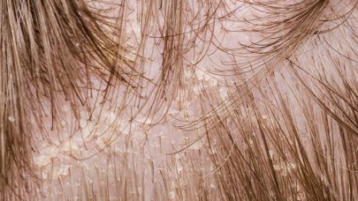 dandruff on scalp