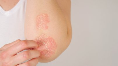 Psoriazė