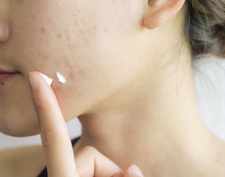Kaip gydyti aknės paveiktą odą