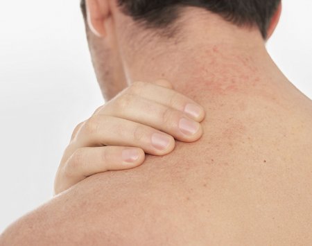 Atopinis dermatitas ant nugaros