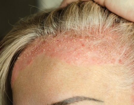 psoriasis on forehead and scalp