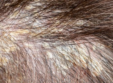 seborėjinis dermatitas ant galvos seborėjinis dermatitas ant galvos