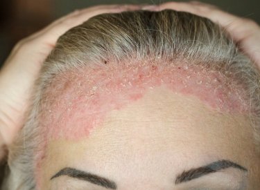 Psoriazė ant kaktos ir galvos Psoriazė ant kaktos ir galvos