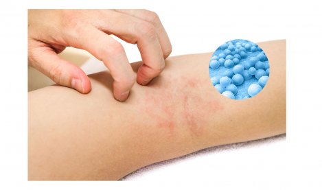 Atopiniam dermatitui (arba atopinei egzemai) būdingas odos paraudimas