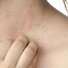 Scratching - Eczema